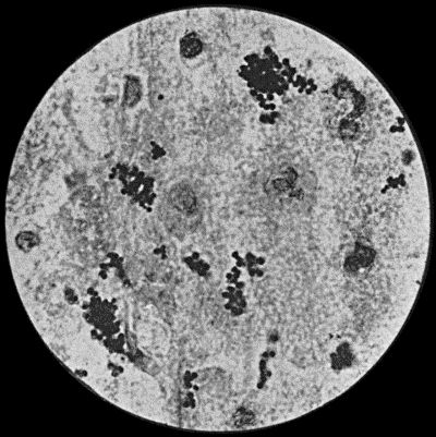 Fig. 2.—Staphylococcus aureus in Pus from case of Osteomyelitis. × 1000 diam. Gram's stain.