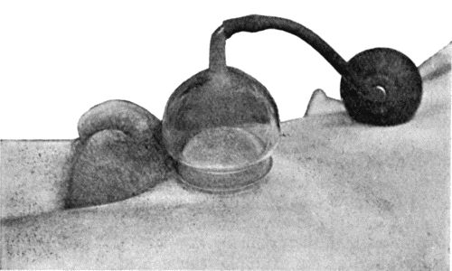 Fig. 8.—Passive Hyperæmia induced by Klapp's Suction Bell for Inflammation of Inguinal Gland.