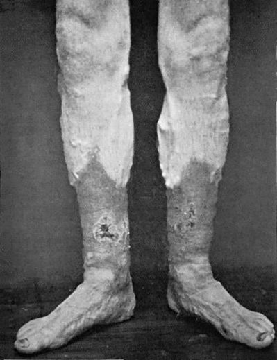 Fig. 14.—Leg Ulcers associated with Varicose Veins and Pigmentation of the Skin.