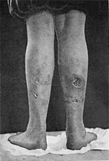 Fig. 16.—Bazin's Disease in a girl æt. 16.