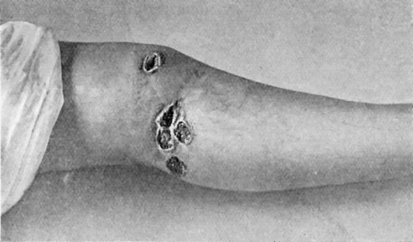 Fig. 17.—Syphilitic Ulcers in region of Knee, showing punched-out appearance and raised indurated edges.
