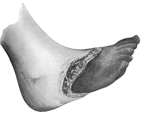 Fig. 20.—Senile Gangrene of the Foot, showing line of demarcation.