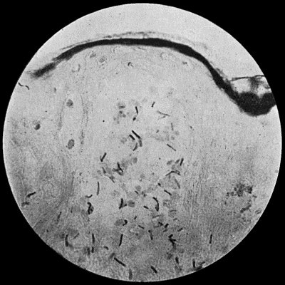 Fig. 27.—Bacillus of Anthrax in section of skin, from a case of malignant pustule; shows vesicle containing bacilli. × 400 diam. Gram's stain.