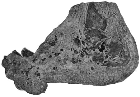 Fig. 32.—Mycetoma, or Madura Foot. (Museum of Royal College of Surgeons, Edinburgh.)
