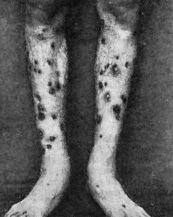 Fig. 39.—Syphilitic Rupia, showing the limpet-shaped crusts or scabs.