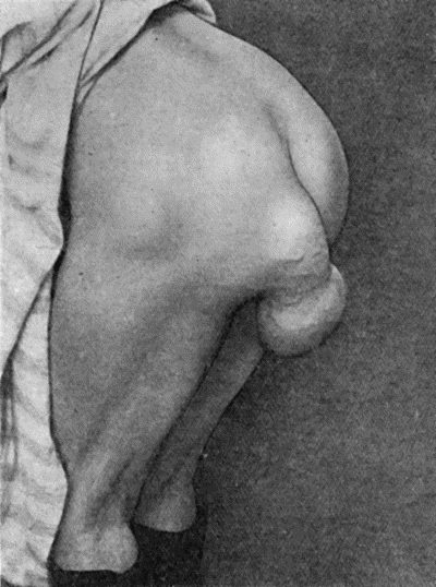 Fig. 46.—Pedunculated Lipoma of Buttock of forty years' duration in a woman æt. 68.
