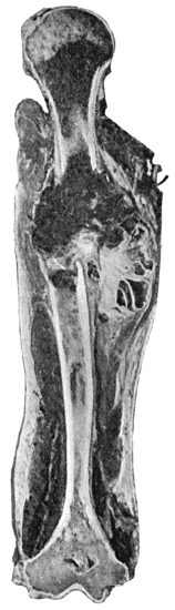 Fig. 53.—Myeloma of Shaft of Humerus, causing pathological fracture. (Mr. J.W. Struthers' case.)  (The unusual site of the tumour is to be noted.)