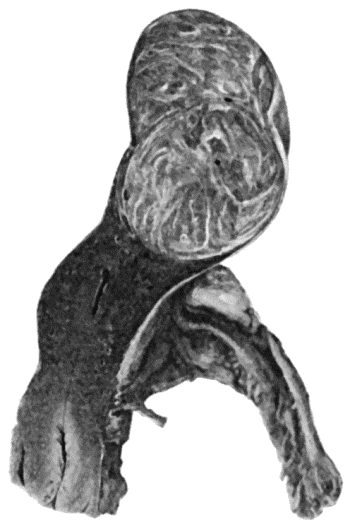 Fig. 54.—Fibro-myoma of Uterus.  (Anatomical Museum, University of Edinburgh.)