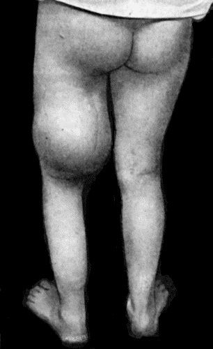 Fig. 55.—Recurrent Sarcoma of Sciatic Nerve in a woman æt. 27. Recurrence twenty months after removal of primary growth.