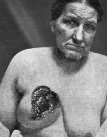 Fig. 57.—Carcinoma of Breast with Cancerous Ulcer.