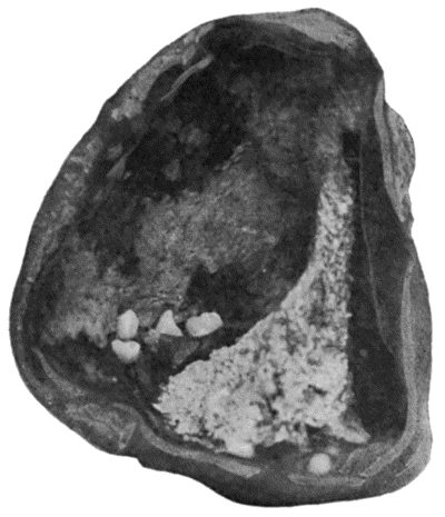Fig. 59.—Dermoid Cyst of Ovary showing Teeth in its interior.
