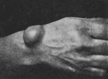 Fig. 60.—Carpal Ganglion in a woman æt. 25.