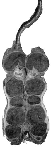 Fig. 66.—Thrombosis in Tortuous and Pouched Great Saphena Vein, in longitudinal section.
