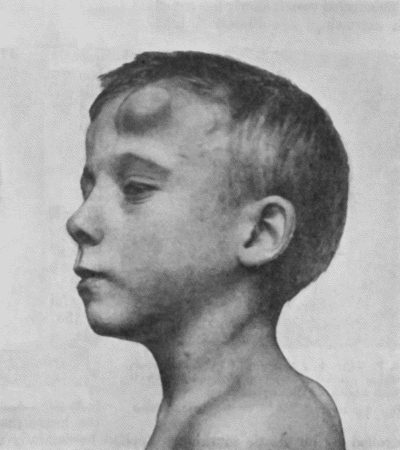 Fig. 69.—Cirsoid Aneurysm of Forehead in a boy æt. 10. (Mr. J.W. Dowden's case.)