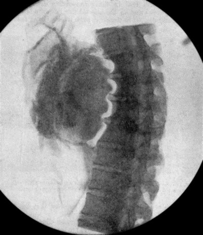 Fig. 71.—Radiogram of Aneurysm of Aorta, showing laminated clot and erosion of bodies of vertebræ. The intervertebral discs are intact.