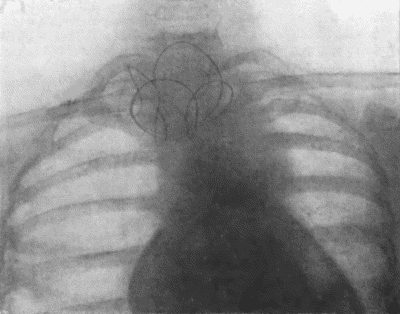 Fig. 73.—Radiogram of Innominate Aneurysm after treatment by the Moore-Corradi method. Two feet of finely drawn silver wire were introduced. The patient, a woman, æt. 47, lived for ten months after operation, free from pain (cf. Fig. 75).