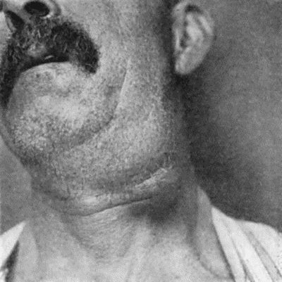 Fig. 83.—Cancerous Glands in Neck secondary to Epithelioma of Lip. (Mr. G.L. Chiene's case.)