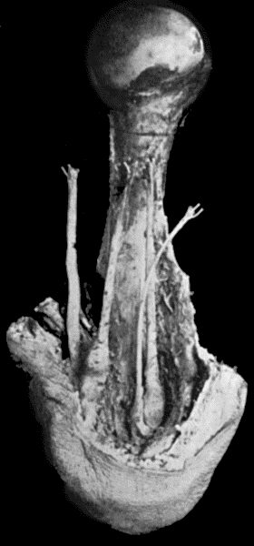 Fig. 85.—Amputation Stump of Upper Arm, showing bulbous thickening of the ends of the nerves, embedded in scar tissue at the apex of the stamp.