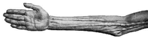 Fig. 86.—Diffuse enlargement of Nerves in generalised Neuro-fibromatosis. (After R.W. Smith.)