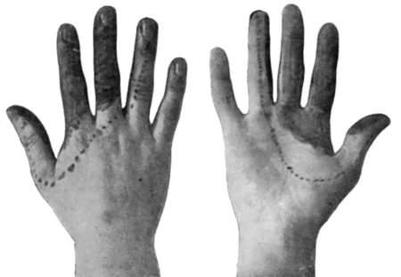 Fig. 91.—To illustrate the Loss of Sensation produced by Division of the Median Nerve. The area of complete cutaneous insensibility is shaded black. The parts insensitive to light touch and to intermediate degrees of temperature are enclosed within the dotted line. (After Head and Sherren.)