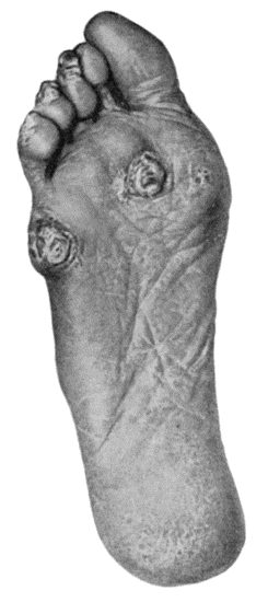 Fig. 93.—Callosities and Corns on the Sole and Plantar Aspect of the Toes in a woman who was also the subject of flat-foot.