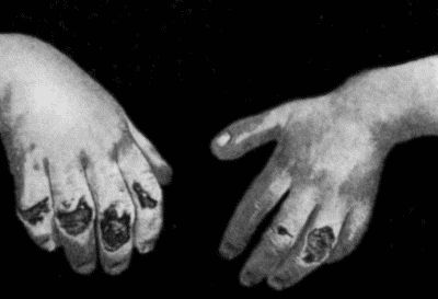 Fig. 94.—Ulcerated Chilblains on Fingers of a Child.