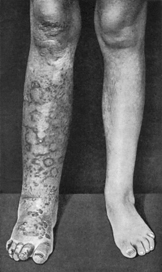 Fig. 96.—Tuberculous Elephantiasis in a woman æt. 35.