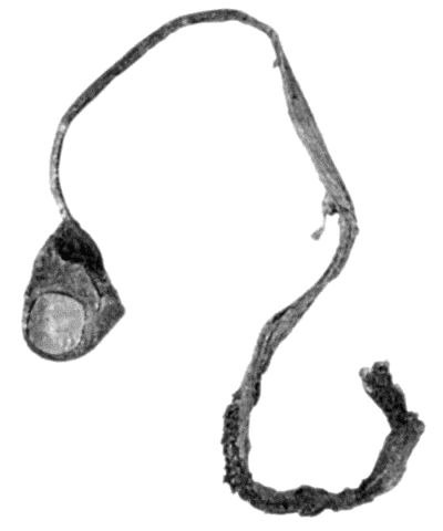 Fig. 108.—Avulsion of Tendon with Terminal Phalanx of Thumb. (Surgical Museum, University of Edinburgh.)