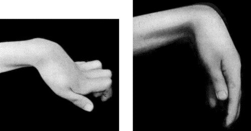 Fig. 109.—Volkmann's Ischæmic Contracture. When the wrist is flexed to a right angle it is possible to extend the fingers. (Photographs lent by Mr. Lawford Knaggs)