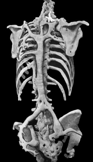 Fig. 112.—Ossification in Muscles of Trunk in a case of generalised Ossifying Myositis. (Photograph lent by Dr. Rustomjee.)