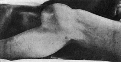 Fig. 113.—Hydrops of Prepatellar Bursa in a housemaid.