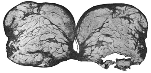 Fig. 114.—Section through Bursa over external malleolus, showing deposit of urate of soda. (Cf. Fig. 117.)