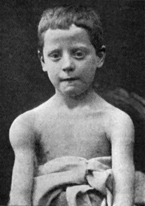 Fig. 115.—Tuberculous Disease of Sub-deltoid Bursa. (From a photograph lent by Sir George T. Beatson.)