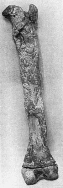Fig. 118.—Shaft of Femur after Acute Osteomyelitis. The shaft has undergone extensive necrosis, and a shell of new bone has been formed by the periosteum.