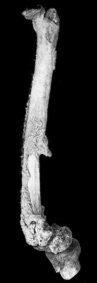 Fig. 119.—Femur and Tibia showing results of Acute Osteomyelitis affecting Trigone of Femur; sequestrum partly surrounded by new case; backward displacement of lower epiphysis and implication of knee-joint.