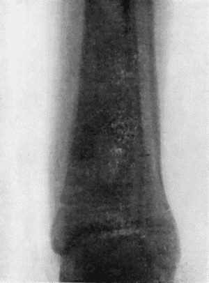 Fig. 121.—Radiogram of Brodie's Abscess in Lower End of Tibia.