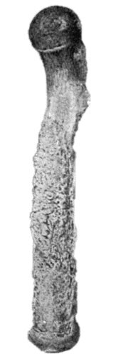 Fig. 123.—New Periosteal Bone on surface of Femur from Amputation Stump. Osteomyelitis supervened on the amputation, and resulted in necrosis at the sawn section of the bone. (Anatomical Museum, University of Edinburgh.)