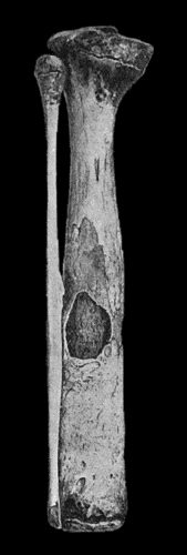 Fig. 125.—Tuberculous Disease of Child's Tibia, showing sequestrum in medullary cavity, and increase in girth from excess of new bone.