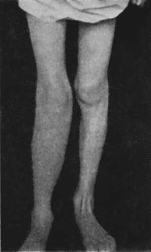 Fig. 126—Diffuse Tuberculous Osteomyelitis of Right Tibia. (Photograph lent by Sir H.J. Stiles.)
