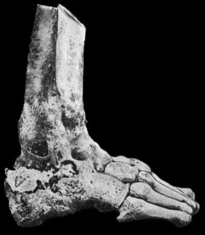 Fig. 127.—Advanced Tuberculous Disease in region of Ankle. The ankle-joint is ankylosed, and there is a large sequestrum in the calcaneus.  (Specimen in Anatomical Museum, University of Edinburgh.)