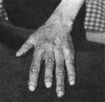 Fig. 129.—Shortening of Middle Finger of Adult, the result of Tuberculous Dactylitis in childhood.