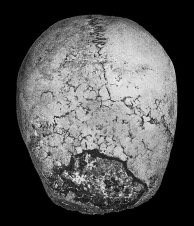 Fig. 130.—Syphilitic Disease of Skull, showing a sequestrum in process of separation.