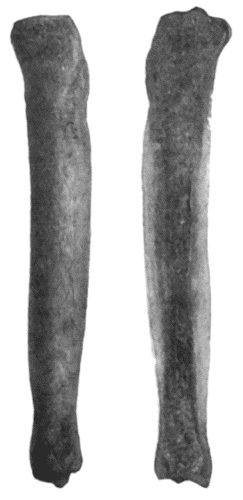 Fig. 131.—Syphilitic Hyperostosis and Sclerosis of Tibia, on section and on surface view.