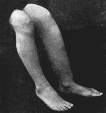 Fig. 132.—Sabre-blade Deformity of Left Tibia in Inherited Syphilis.  (From a photograph lent by Sir George T. Beatson.)