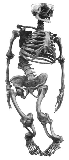 Fig. 133.—Skeleton of Rickety Dwarf, known as "Bowed Joseph," leader of the Meal Riots in Edinburgh, who died in 1780. (Anatomical Museum, University of Edinburgh.)