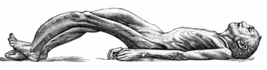 Fig. 135.—Cadaver, illustrating the alterations in the Lower Limbs resulting from Ostitis Deformans.