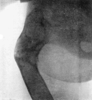 Fig. 137.—Radiogram of Upper End of Femur showing appearances in Osteomyelitis Fibrosa.