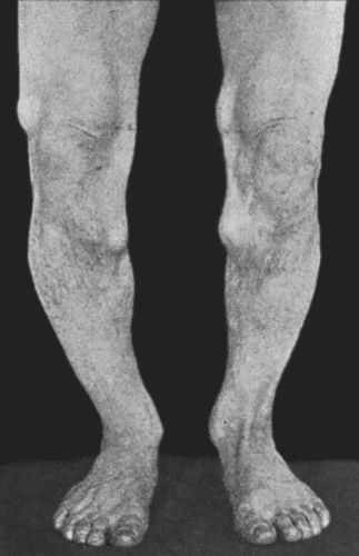 Fig. 139.—Multiple Exotoses of both limbs. (Photograph lent by Sir George T. Beatson.)