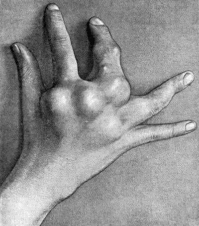 Fig. 142.—Multiple Chondromas of Phalanges and Metacarpals in a boy æt. 10 (cf. Fig. 143).