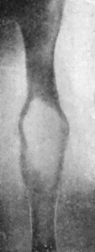 Fig. 145.—Radiogram of Myeloma of Humerus. (Mr. J.W. Struthers' case.)